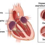 схема аортального клапана