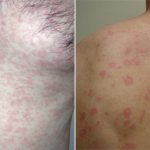 syphilitic roseola rash due to syphilis