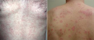 syphilitic roseola rash due to syphilis