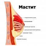Symptoms of acute mastitis
