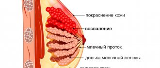 Symptoms of acute mastitis