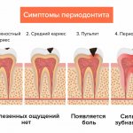 Симптомы периодонтита в картинках: от бессимптомной стадии до сильной боли.