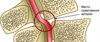 Vertebral artery syndrome