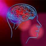 Vascular dementia - imaging