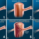 Degrees of aortic aneurysm dissection