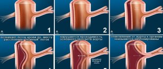 Степени расслаивания аневризмы аорты