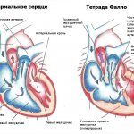 Tetralogy of Fallot