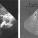 Ultrasound of the liver