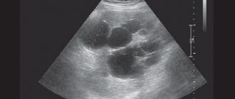 Ultrasound of the spleen shows what