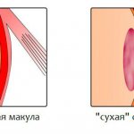 Age-related macular degeneration (AMD) - what is it and why is it dangerous?