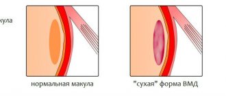 Возрастная макулодистрофия (ВМД)- что это такое и чем опасно